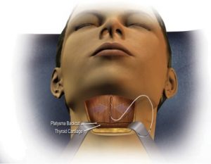 Deep Neck Contouring for Rochester, Buffalo & Syracuse, NY