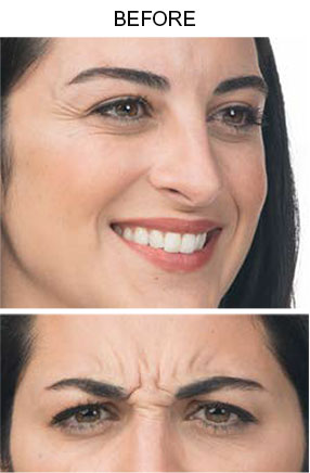 Botox