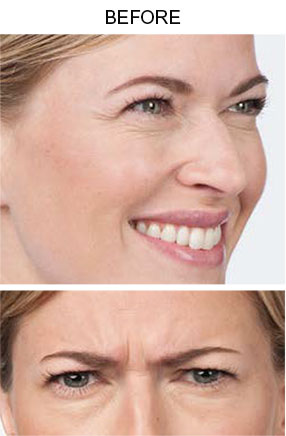 Botox