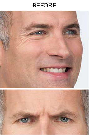 Botox